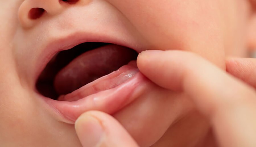 Chậm mọc răng: Nguyên nhân, phòng tránh và Quá trình mọc răng của trẻ - ảnh 2