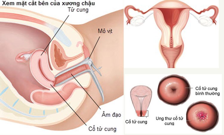 Sinh thiết cổ tử cung: Những điều cần biết - ảnh 1