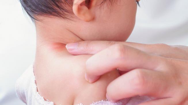 Trẻ sơ sinh bị zona: Những điều cần biết