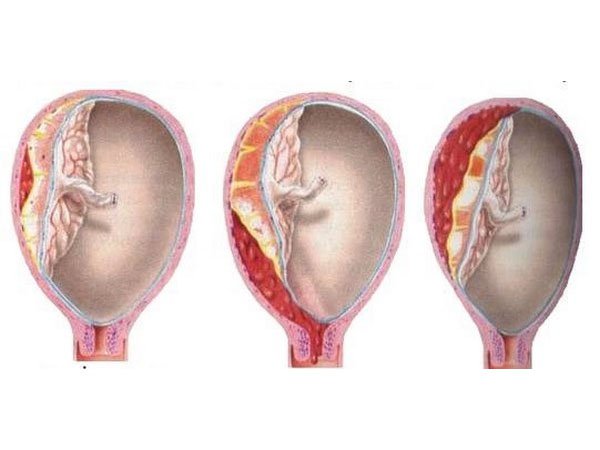 Bóc tách túi thai khi mang bầu có nguy hiểm không?