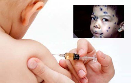 Vắc-xin Varilrix (Bỉ) - ảnh 2
