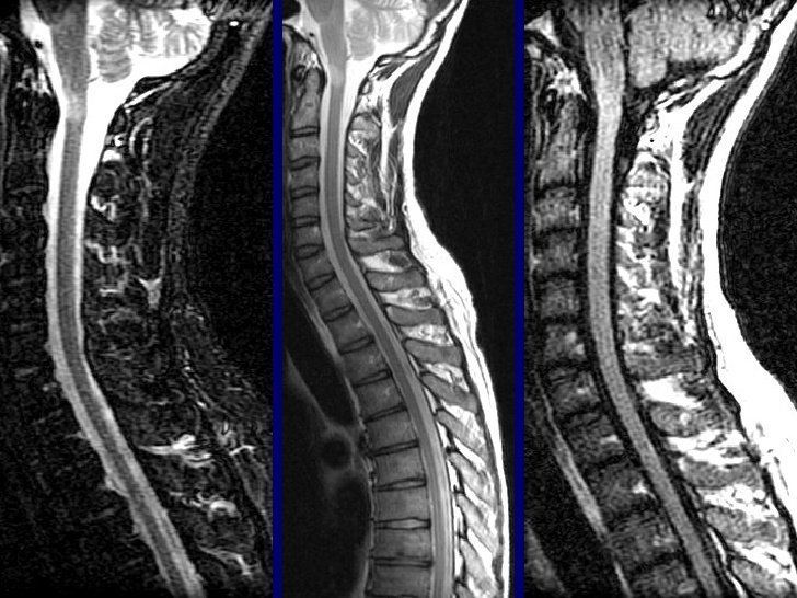 Chụp cộng hưởng từ MRI chẩn đoán thoát vị cột sống - ảnh 2