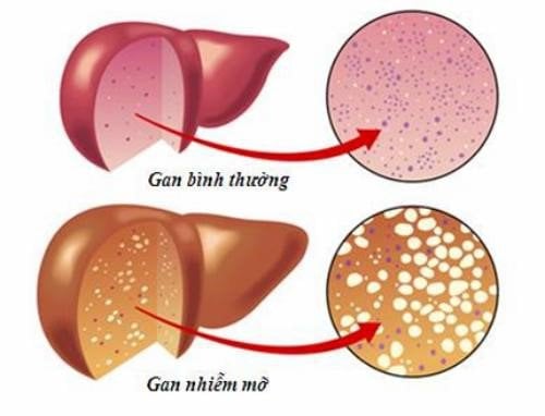 Những điều cần biết về gan nhiễm mỡ - ảnh 1