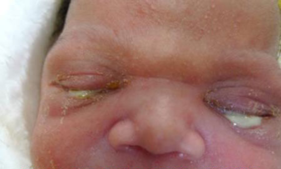 Nguy cơ viêm kết mạc ở trẻ sơ sinh có mẹ nhiễm lậu - ảnh 2