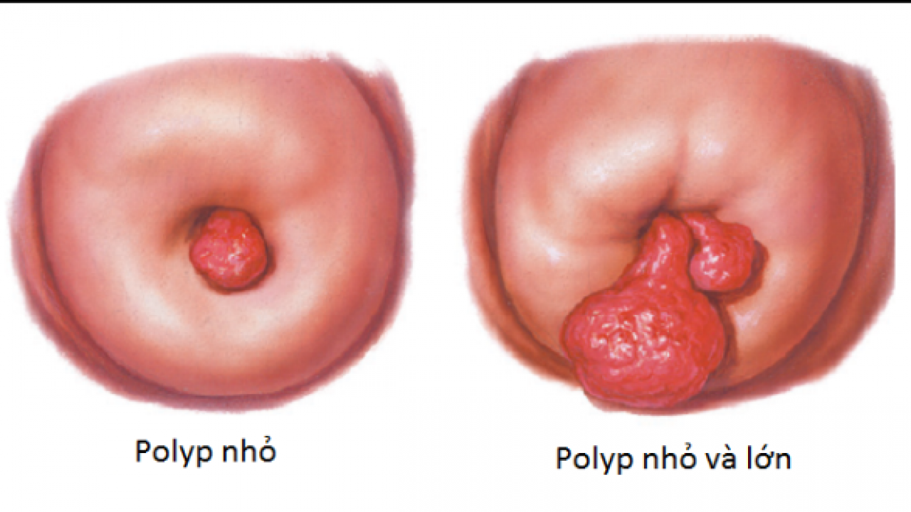 Polyp buồng tử cung là bệnh gì? Phẫu thuật cắt polyp qua soi buồng tử cung - ảnh 2