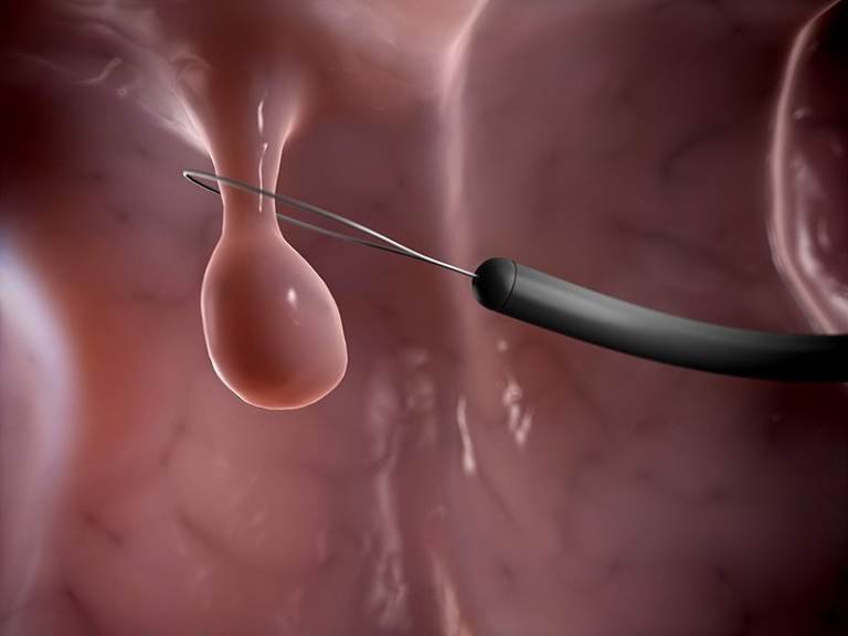 Polyp buồng tử cung là bệnh gì? Phẫu thuật cắt polyp qua soi buồng tử cung