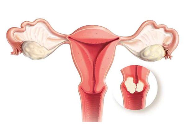 Dính buồng tử cung là gì?, Biểu hiện nhận biết, Nguyên nhân gây vô sinh nữ - ảnh 1