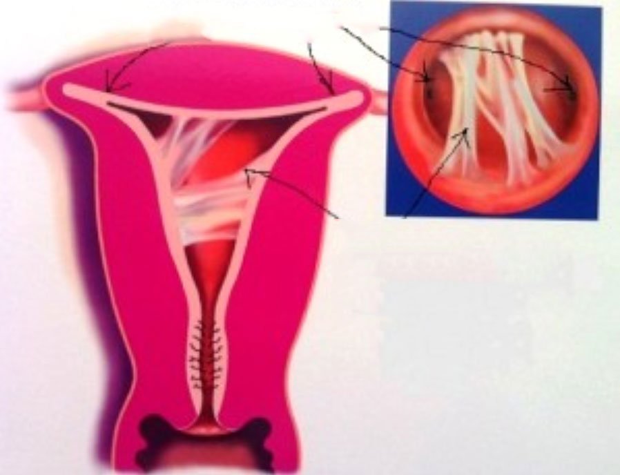 Dính buồng tử cung sau hút thai: Nguy cơ, phòng ngừa và Chăm sóc - ảnh 1