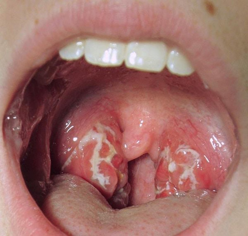 Triệu chứng nhận biết viêm họng hạt và Phòng ngừa viêm họng hạt tái phát