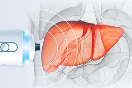 FibroScan đo độ đàn hồi và độ nhiễm mỡ của gan được sử dụng để đánh giá mức độ Xơ gan - ảnh 1