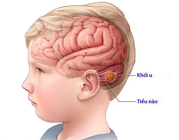 Trẻ em cần lưu ý gì khi chụp cộng hưởng từ sọ não - ảnh 3