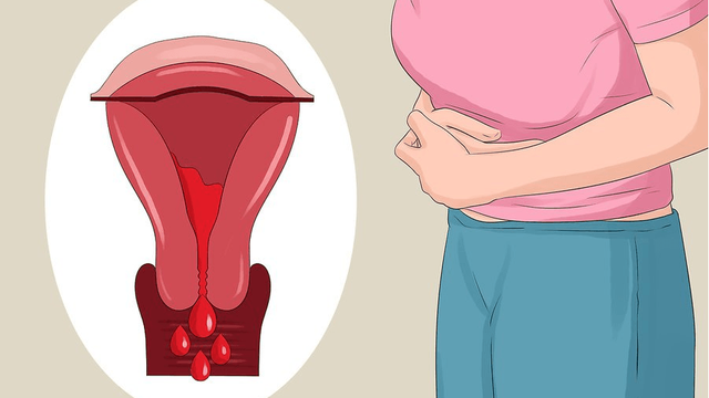Lạc nội mạc tử cung và các vấn đề về ống dẫn trứng