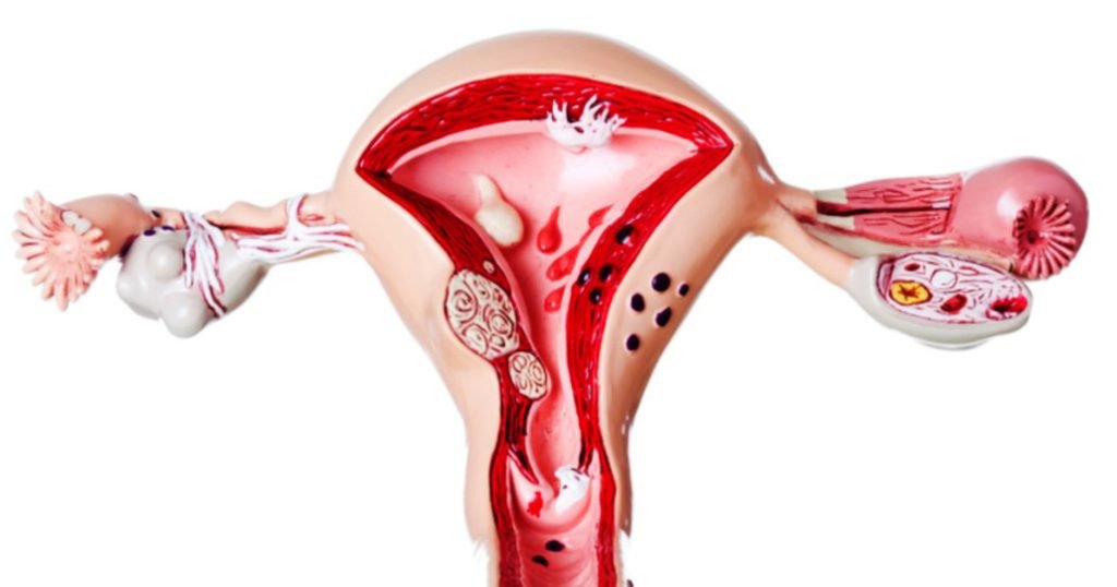 Lạc nội mạc tử cung và các vấn đề về ống dẫn trứng - ảnh 1
