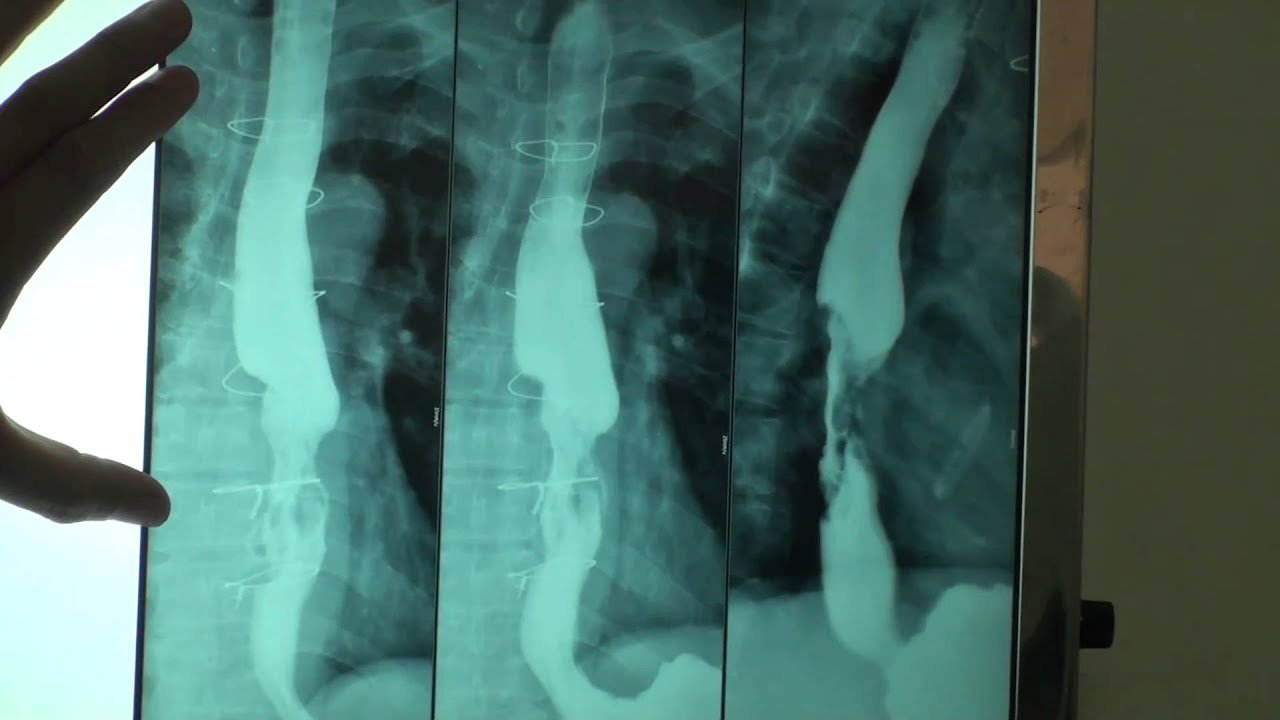 Chụp X quang thực quản - dạ dày diễn ra thế nào? - ảnh 3