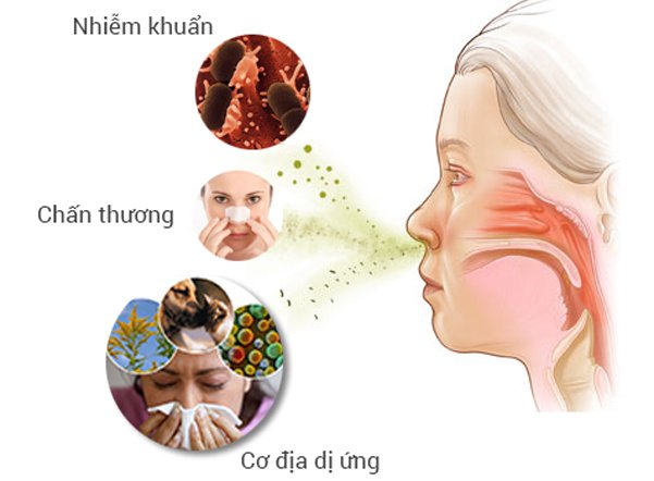 Viêm mũi dị ứng do phấn hoa: Triệu chứng, phòng tránh và Cách điều trị - ảnh 1