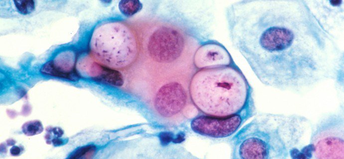 Bệnh do nhiễm Chlamydia Trachomatis sinh dục – tiết niệu - ảnh 6