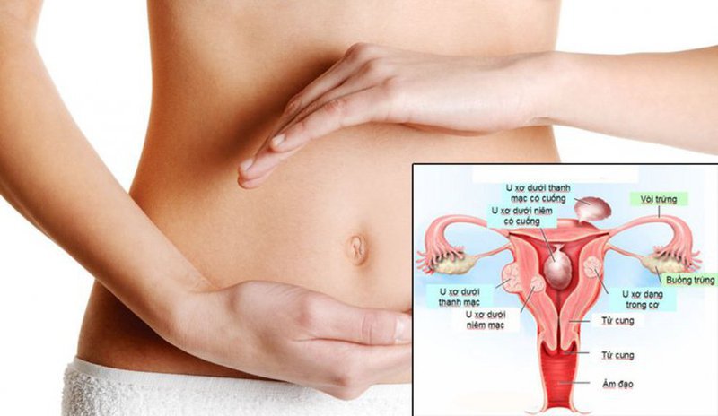 U xơ tử cung là bệnh gì? Nguyên nhân, triệu chứng, Cách phòng tránh