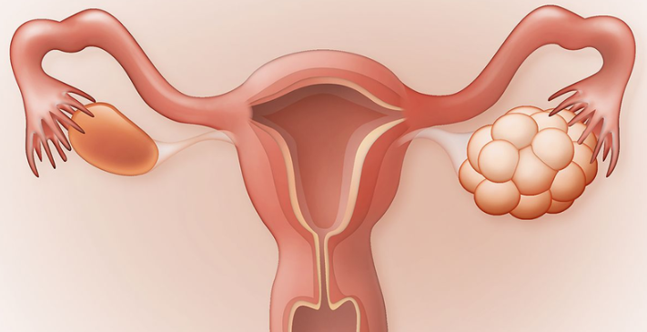 Vai trò của xét nghiệm nội tiết AMH chuẩn đoán khả năng sinh sản ở nữ giới - ảnh 2