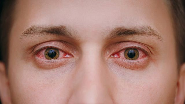 Viêm kết mạc mắt là bệnh gì? Các loại viêm kết mạc mắt thường gặp