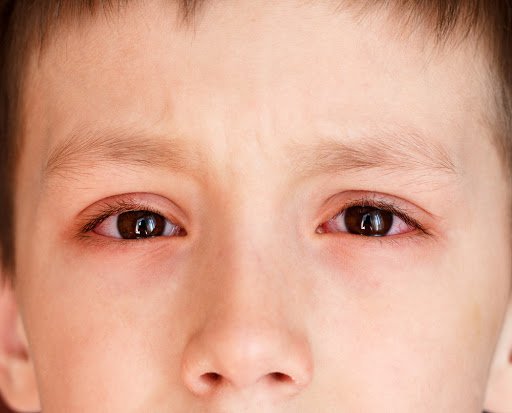Viêm kết mạc mắt là bệnh gì? Các loại viêm kết mạc mắt thường gặp - ảnh 5
