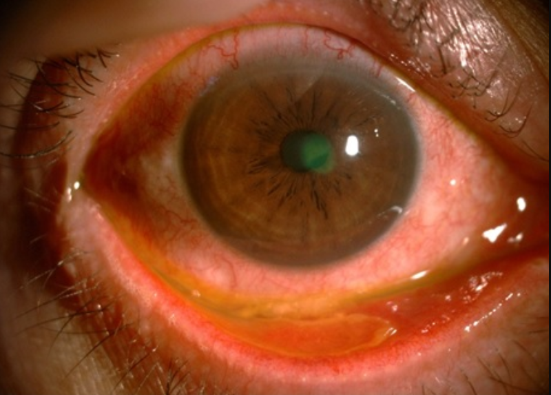 Viêm kết mạc mắt là bệnh gì? Các loại viêm kết mạc mắt thường gặp - ảnh 3