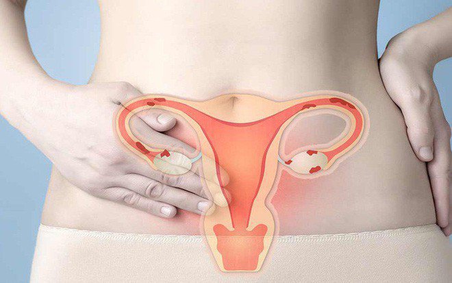 Nội soi buồng tử cung chẩn đoán vô sinh hiếm muộn