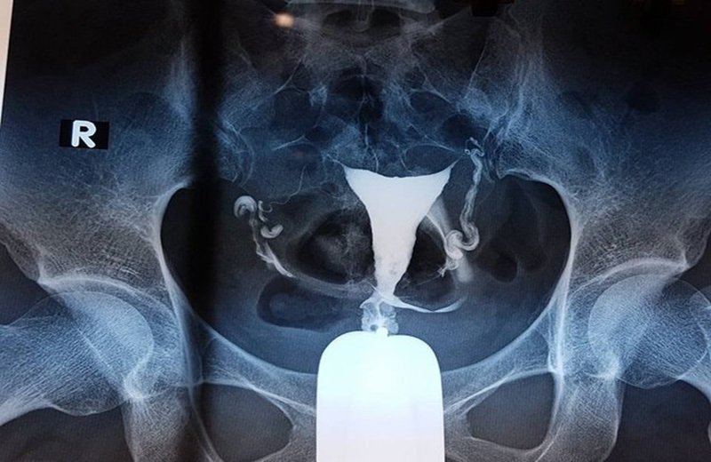 Tại sao khó có thai thì nên chụp X-quang tử cung- vòi tử cung?