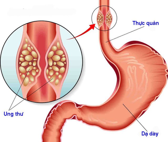 Cắt thực quản qua nội soi ngực bụng điều trị ung thư thực quản