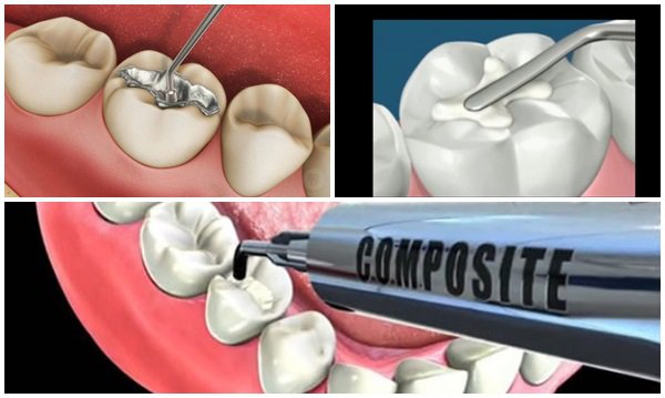 Tác hại của sâu răng và Lợi ích của việc hàn răng sâu sớm - ảnh 3