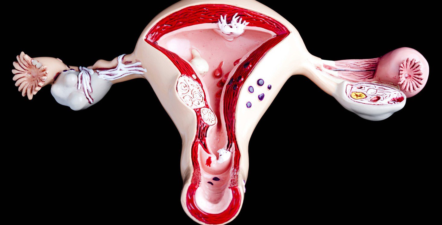 Các loại ung thư cổ tử cung phụ nữ cần biết - ảnh 3