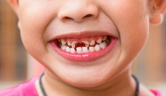 Tác hại của sâu răng và Lợi ích của việc hàn răng sâu sớm