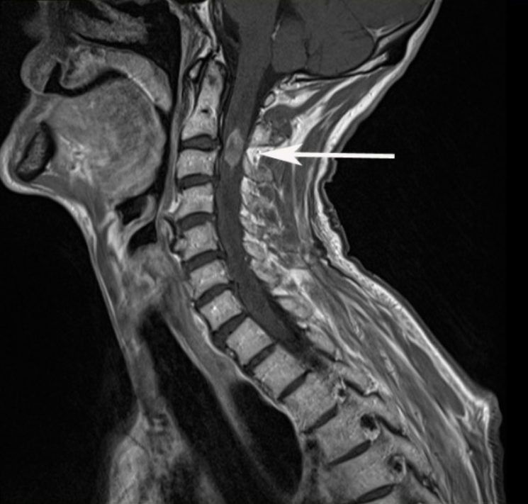 Cách đọc kết quả chụp cộng hưởng từ (MRI) cột sống cổ - ảnh 2