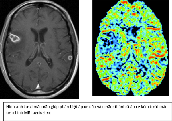 Chụp cộng hưởng từ tưới máu não (MRI perfusion) - P1 - ảnh 3