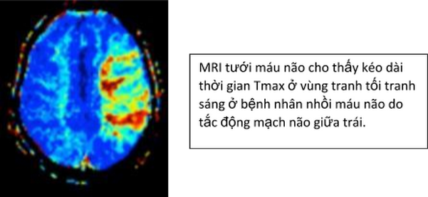 Chụp cộng hưởng từ tưới máu não (MRI perfusion) - P1 - ảnh 2