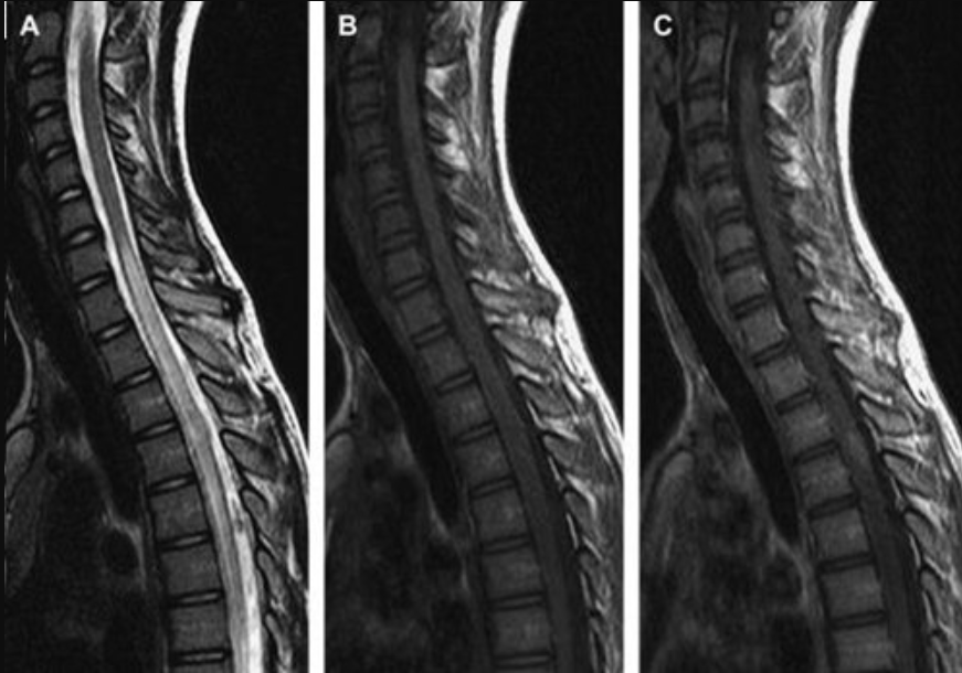 Cách đọc kết quả chụp cộng hưởng từ (MRI) cột sống cổ - ảnh 3