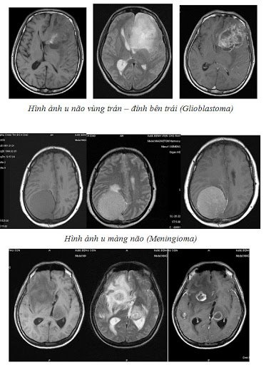 Chụp cộng hưởng từ tưới máu não (MRI perfusion) - P2 - ảnh 2