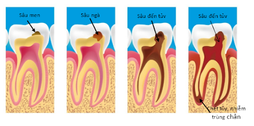 Hàn răng sâu hay trám răng là gì? và Những điều cần biết - ảnh 1