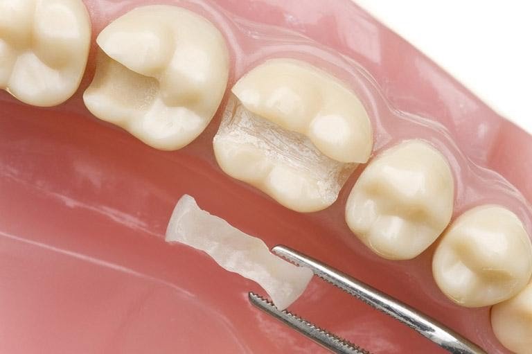 Hàn răng sâu hay trám răng là gì? và Những điều cần biết - ảnh 3