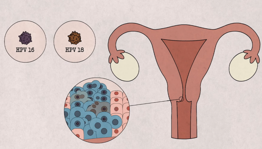 Những điều cần biết HPV và ung thư cổ tử cung - ảnh 2