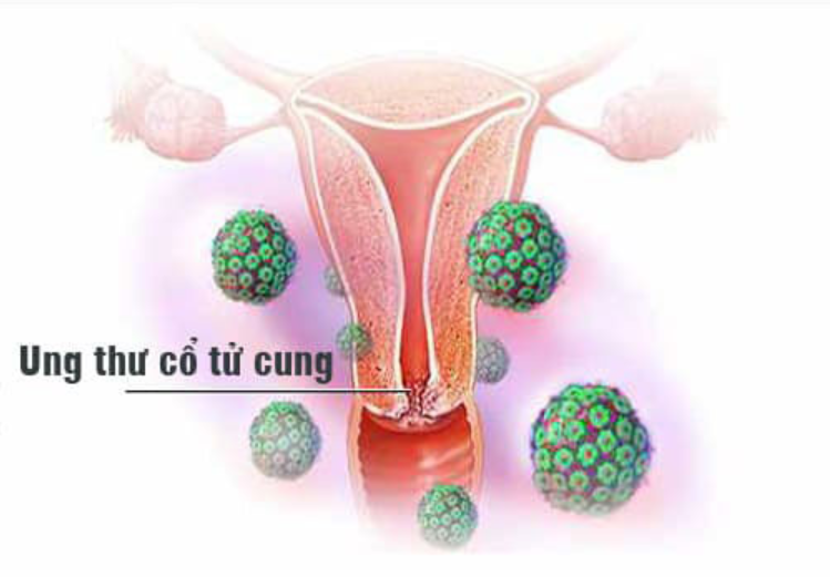 Những điều cần biết HPV và ung thư cổ tử cung
