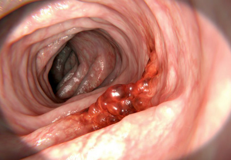 Tai biến có thể gặp trong phẫu thuật nội soi cắt đại tràng mở rộng - ảnh 2