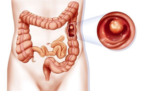 Tìm hiểu các polyp đại tràng có tính chất gia đình - ảnh 1