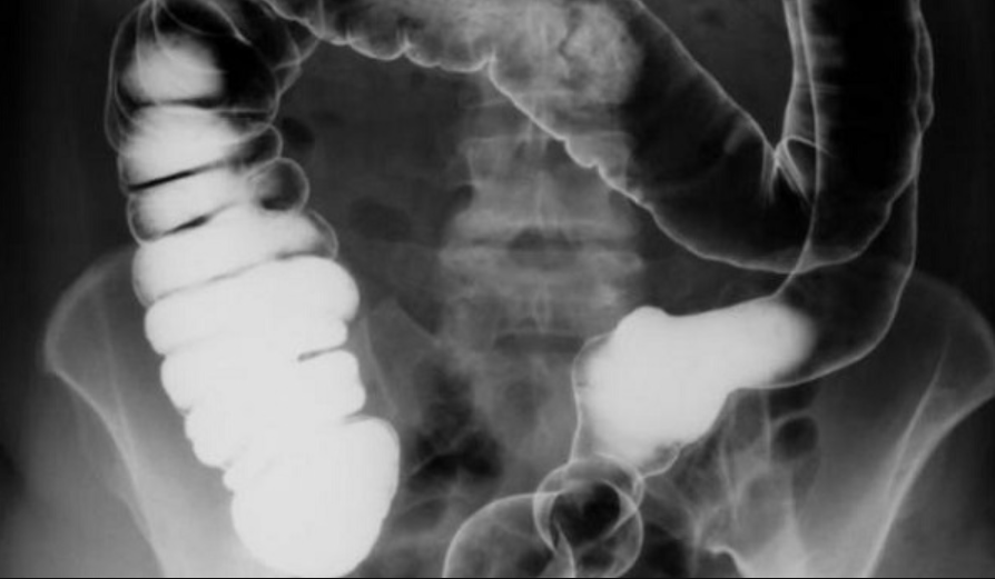 Chụp X - quang đường tiêu hóa có thuốc cản quang - ảnh 1