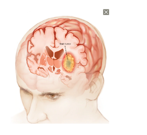 Chụp cộng hưởng từ tưới máu não: Những điều cần biết - ảnh 2