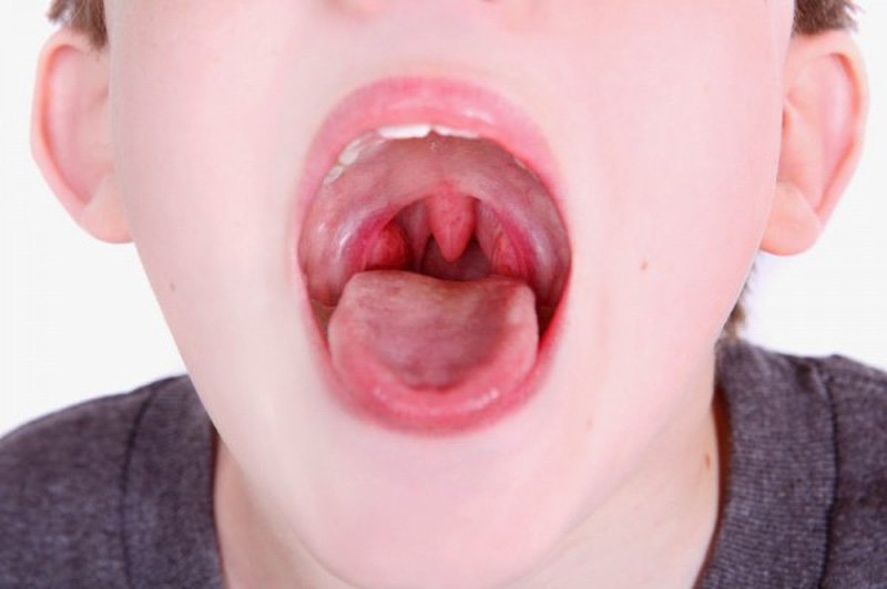 Phân biệt Viêm amidan và viêm họng liên cầu khuẩn khác nhau như thế nào?