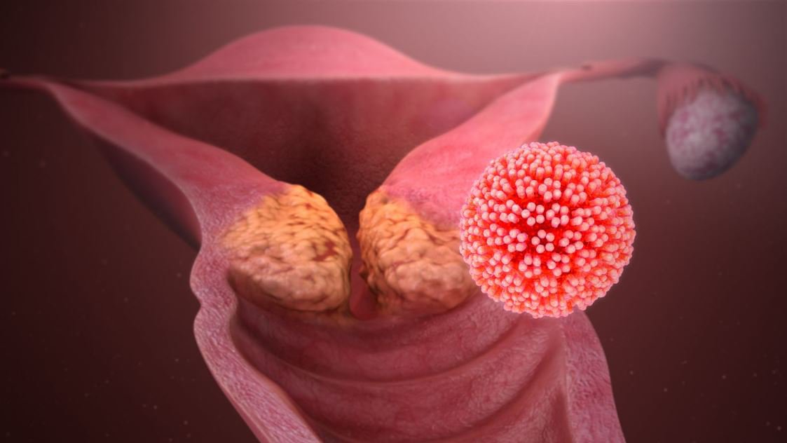 Mới tiêm ngừa ung thư cổ tử cung HPV có nên quan hệ tình dục? - ảnh 1