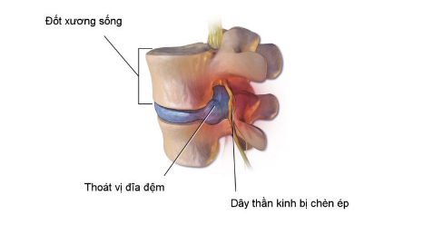 Các bước tiến hành phẫu thuật nội soi lấy thoát vị đĩa đệm cột sống cổ đường sau - ảnh 1