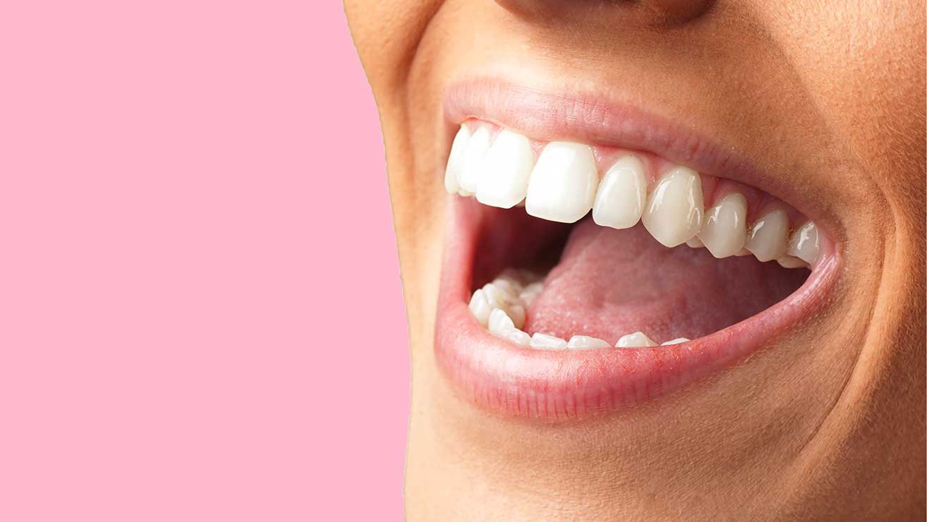 Răng sâu nên bọc răng sứ hay trám răng? - ảnh 4