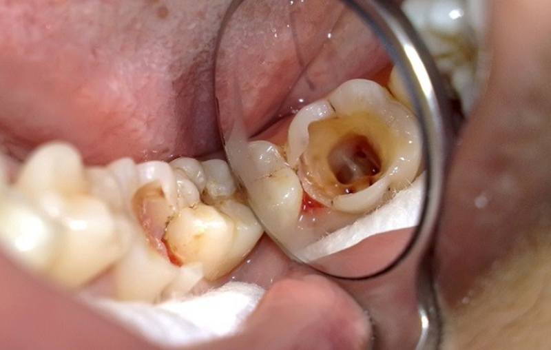 Răng sâu nên bọc răng sứ hay trám răng?