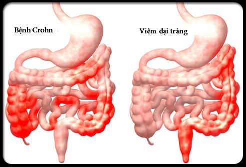Bệnh vảy nến và mối liên với bệnh Crohn (viêm ruột từng vùng)